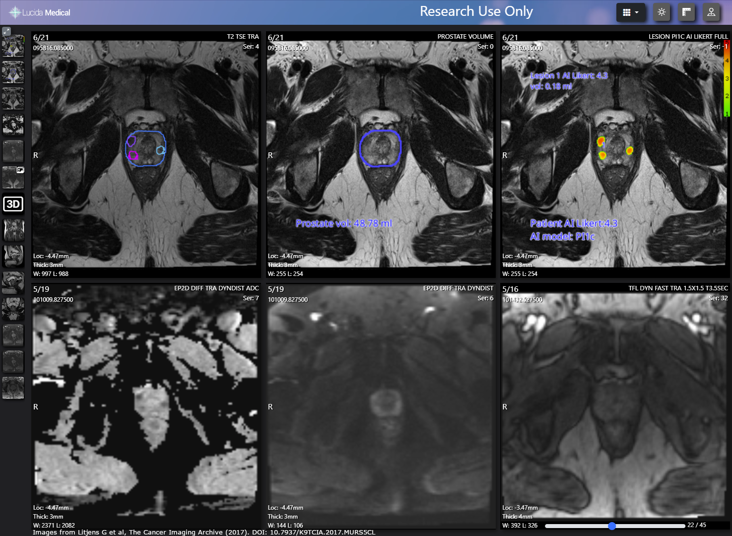 View of prostate MRI study annotated by Lucida Medical Prostate Intelligence AI
